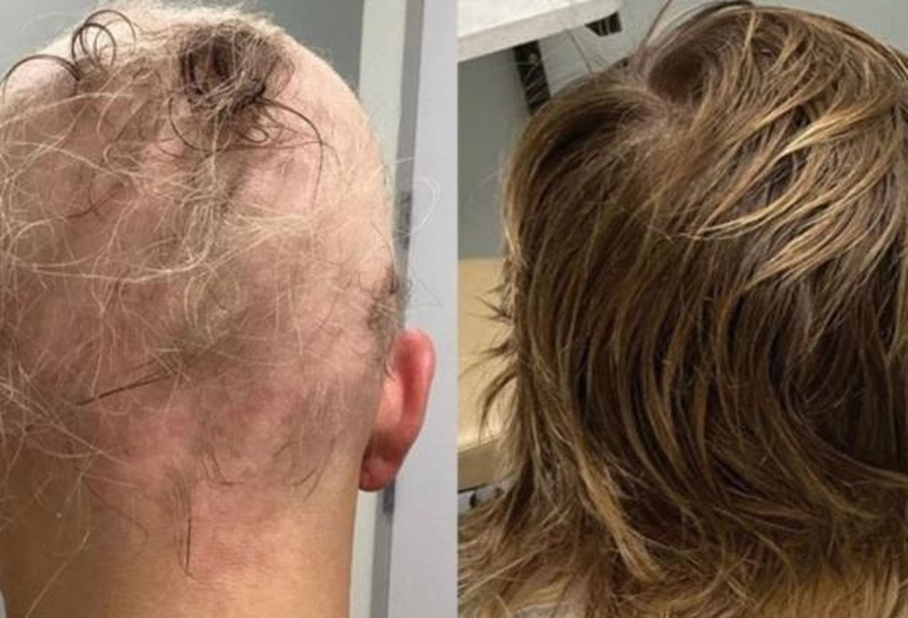 Before and After — male, 3 months