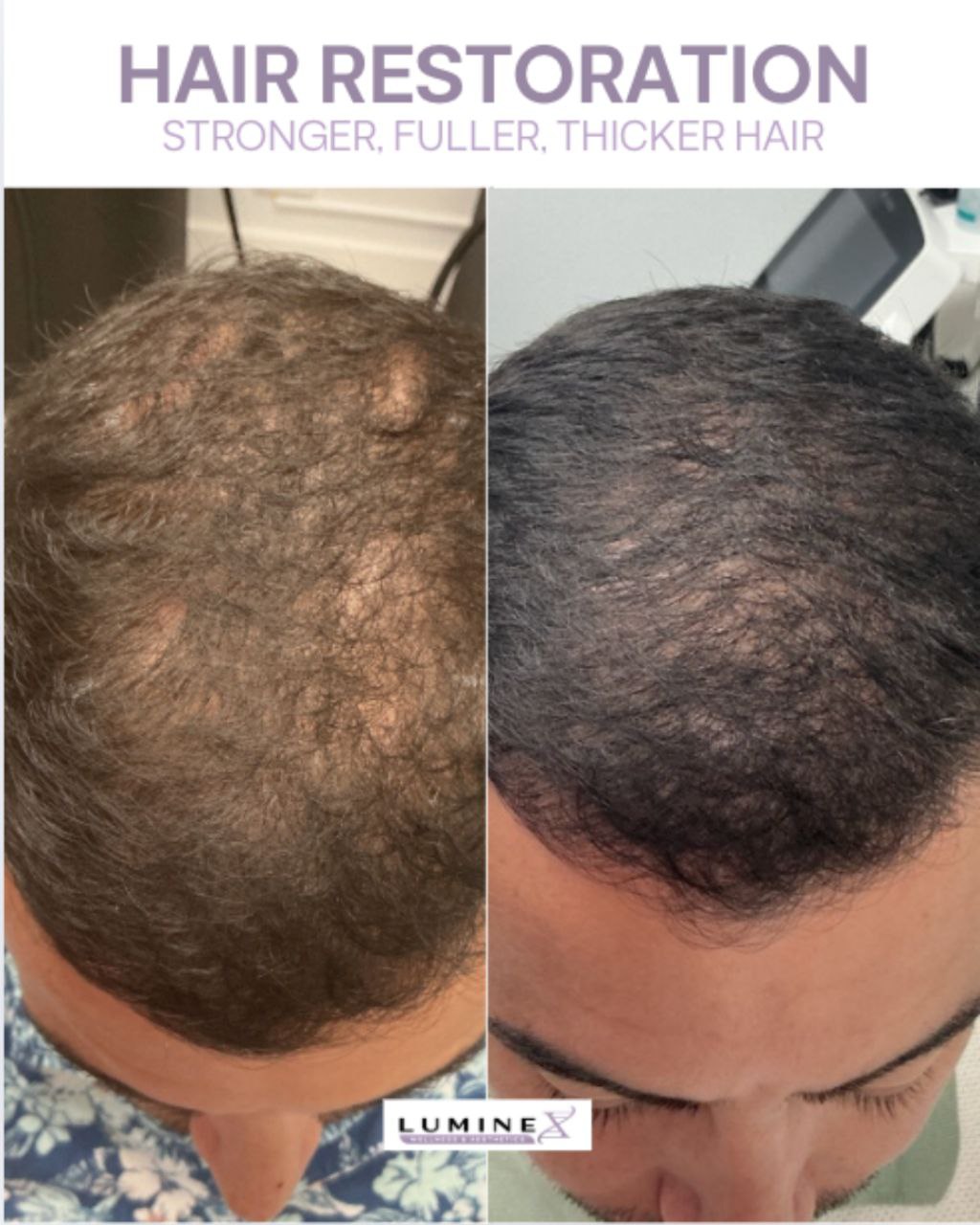 Before and After — crown area