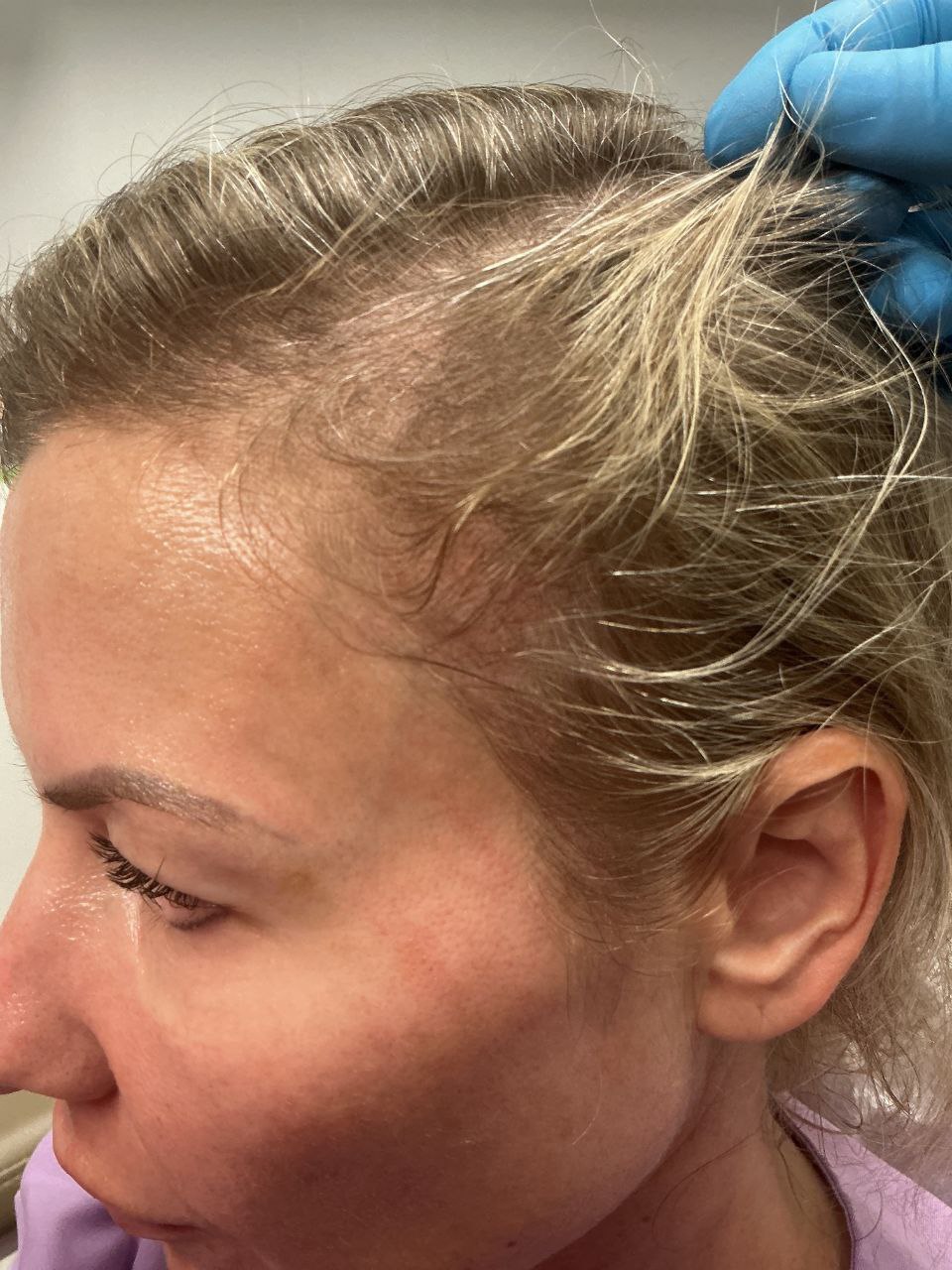 Before treatment — hairline